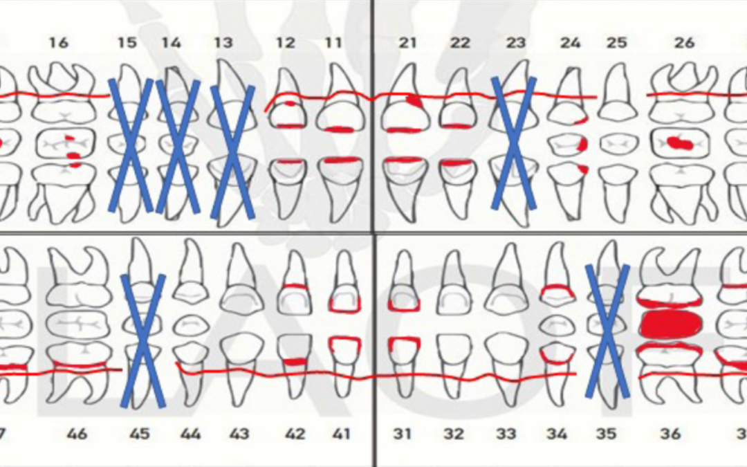 Artículo original de la LCF: La caries rampante en cuatro condiciones para la identificación de personas