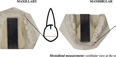 Nueva publicación ENACIF: Sex diagnosis by mesiodistal distances in permanent canines from Mexican population